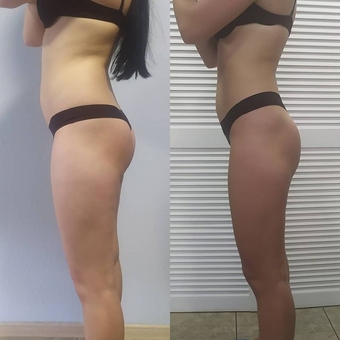 Антицеллюлитный массаж запорожье цена