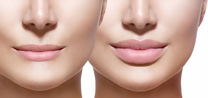 Lip contouring at the Eridan Center in Kiev. Sign up for the procedure for the promotion.